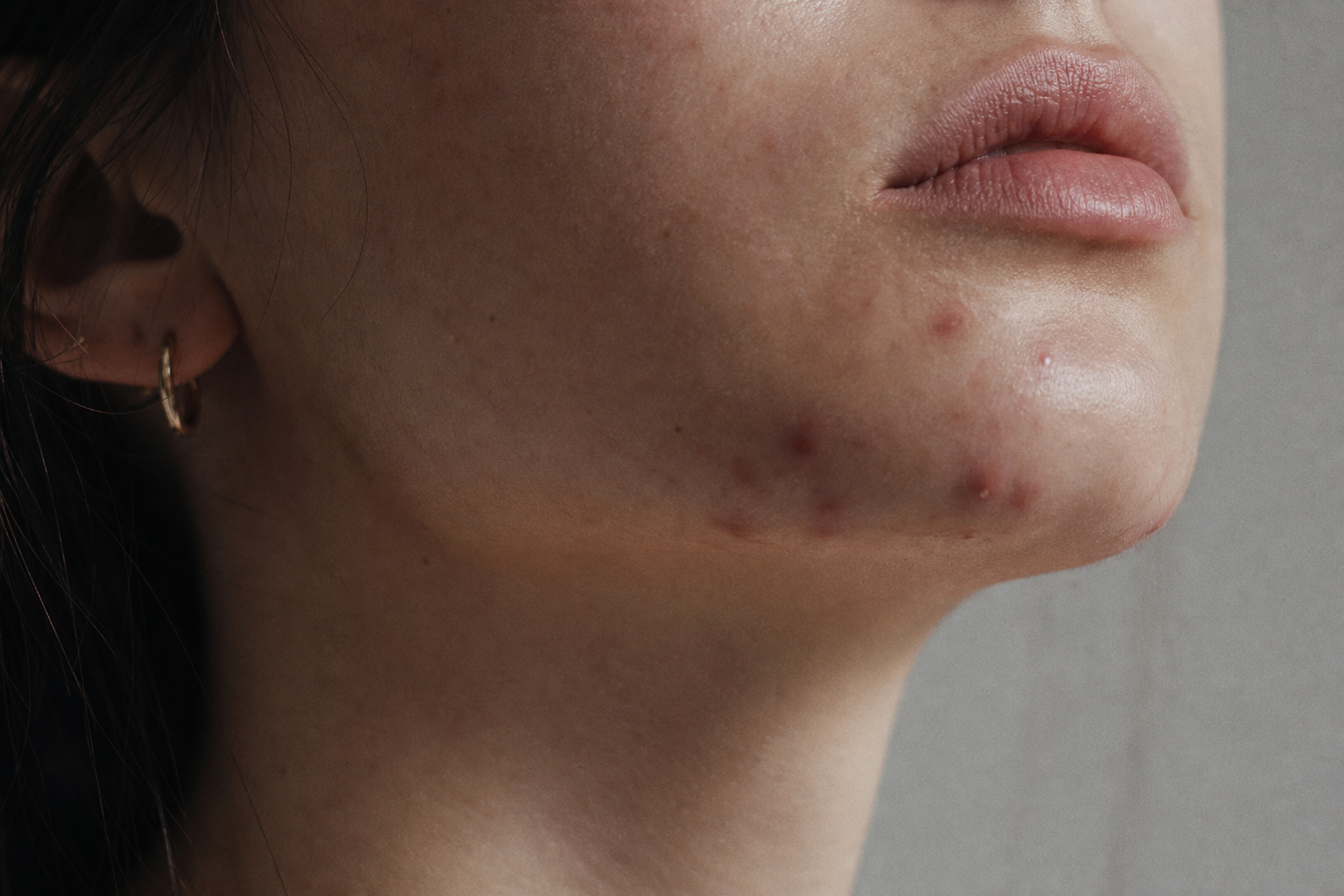 Boutons au menton : causes hormonales, traitements et routine adaptée