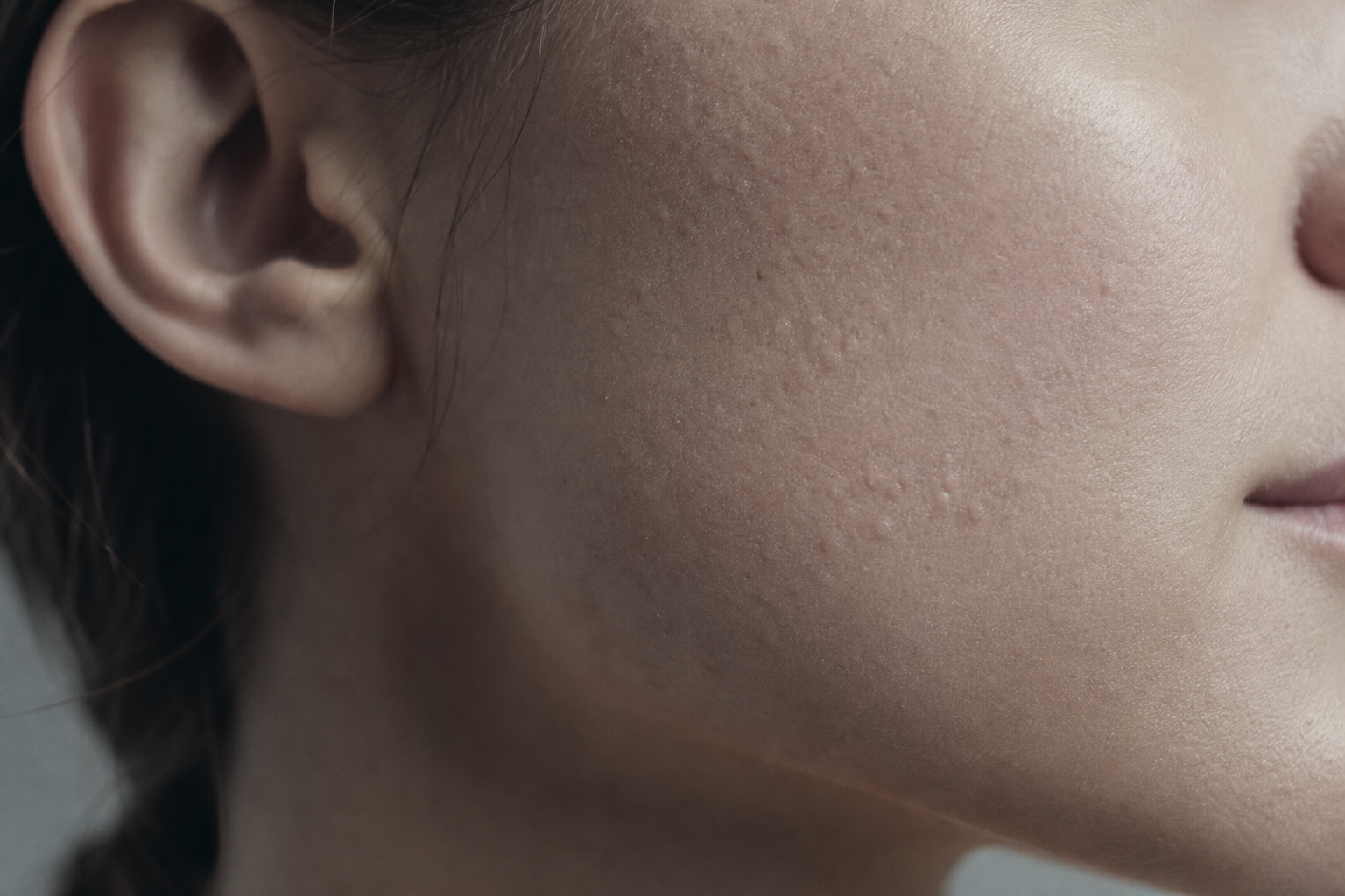 Microkystes au visage : comprendre et éliminer ces petits boutons sous la peau